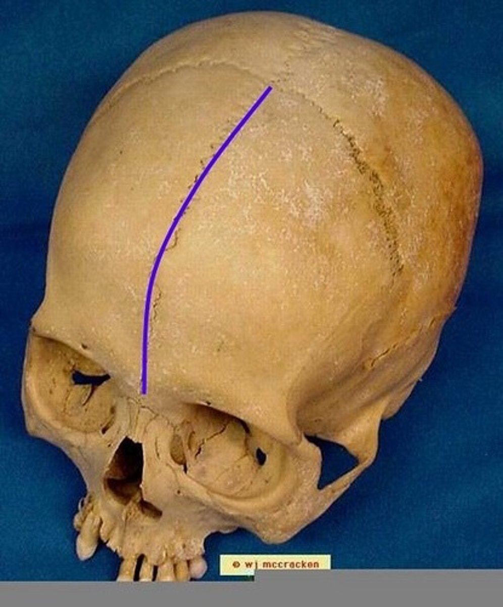 <p>suture located between the right &amp; left frontal, normally fuses together before birth</p>