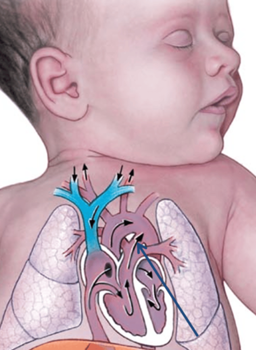 <p>Name this fetal passageway.</p>