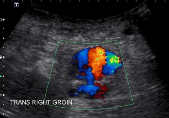 <p>Pt is s/p cardiac catherization RT groin x 2 days. Patient presents with pain, palpable pulsatile mass RT groin. Duplex arterial ultrasound ordered to evaluate area of pain. Consider this image taken in area of pain. </p><p>1.What is most likely diagnosis? </p><p>2.What is important in patient history supporting diagnosis? </p><p>3.It is possible to have another vascular finding with this patient history and diagnosis. What is it? </p><p>4.Why is sonographer using abdominal curved probed?</p>