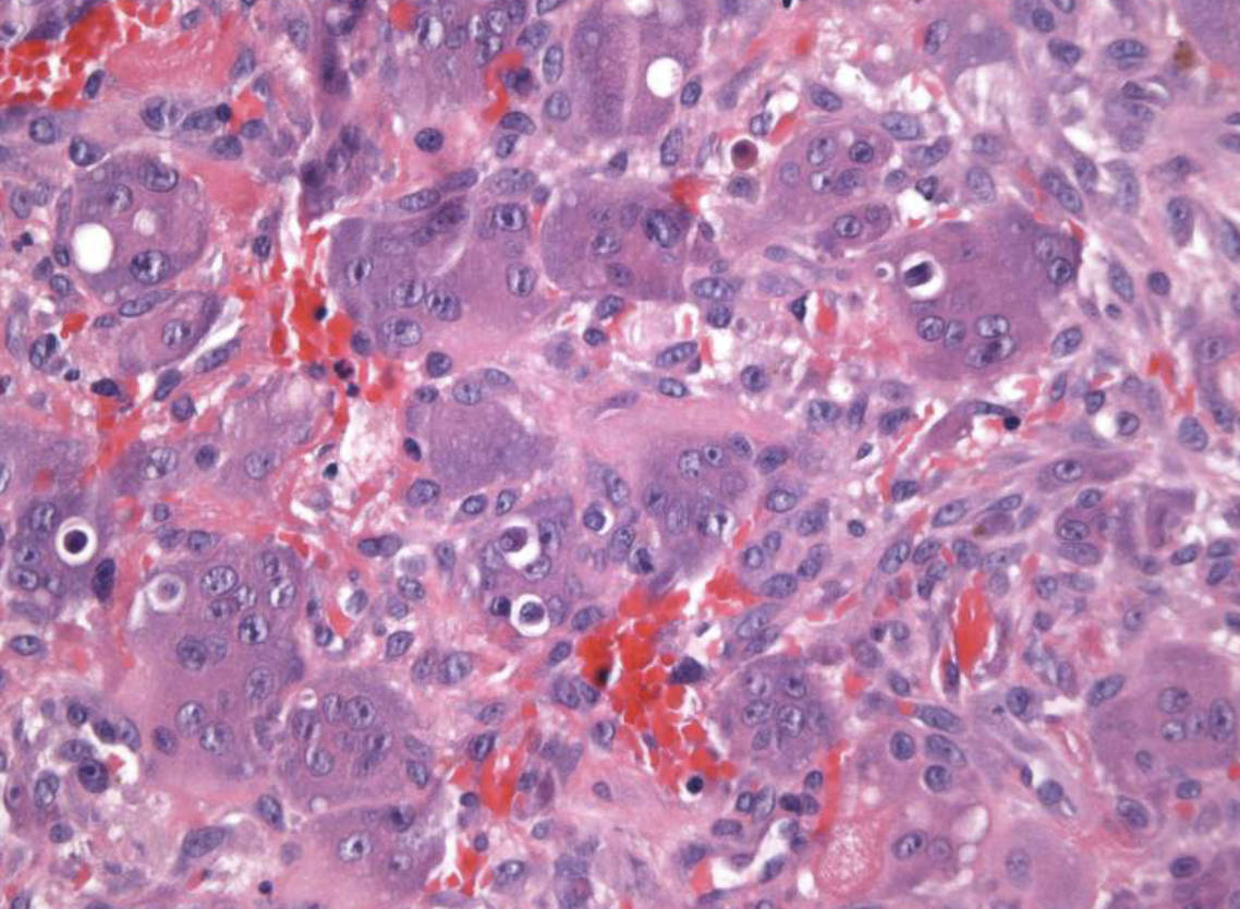 <ol><li><p>multi-nucleated giant cells </p></li><li><p>background of ovoid-spindle shaped mesenchymal cells </p></li></ol><p></p>