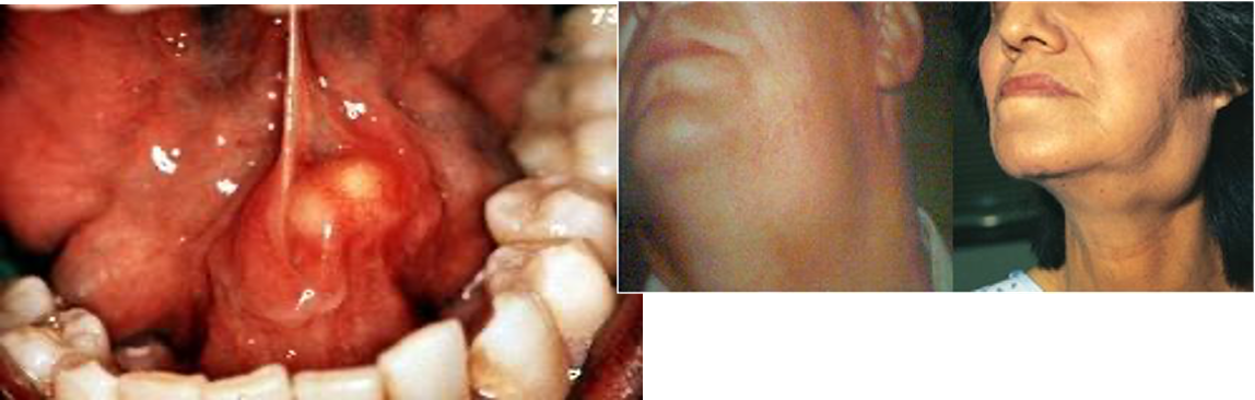 <p>inflammation of salivary gland; pain &amp; edema with/after meals</p>