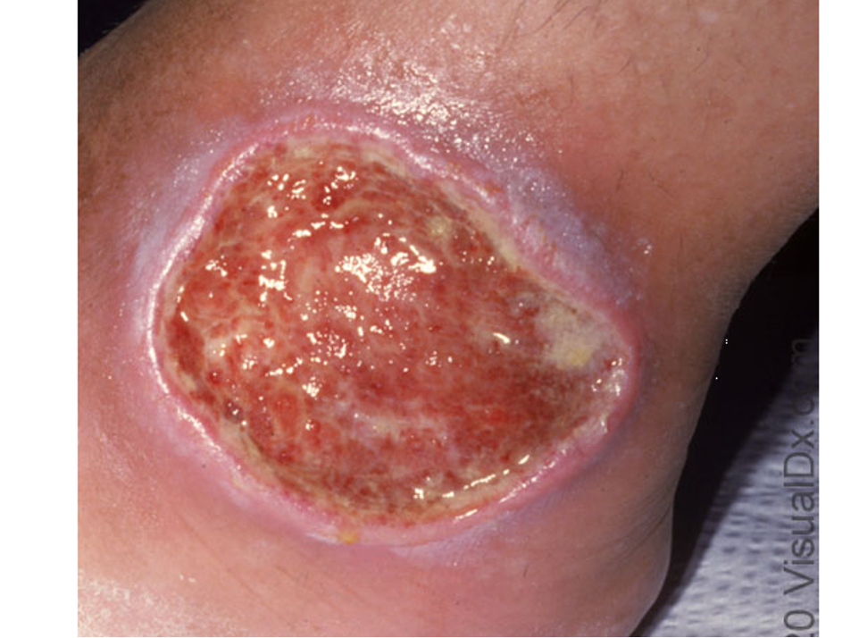 <p>red, pruritic patches of stasis dermatitis precede ulceration; pain w/ ambulation; non healing ulcers; leg edema</p><p>usually on medial aspect of lower legs above malleolus</p>