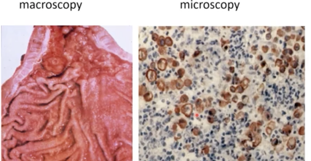 <p>The tumour is everywhere so the organ looks the same but the wall thickens. By blowing air into the stomach we can see if the wall is stiff → bad sign</p><ul><li><p>The brown cells are tumour cells even if they are individual → why we call it diffuse type</p></li><li><p>They are associated with pertineal metastasis (abdominal wall)</p></li></ul>