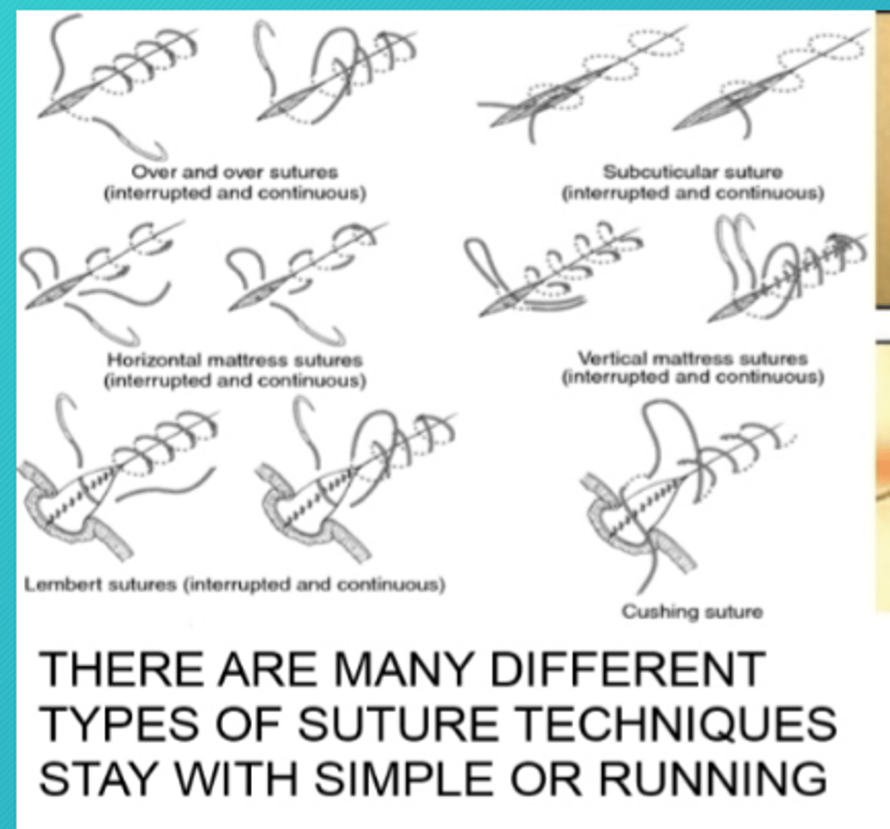 <p>-continuous running stitch (simple continuous)</p><p>-continous running, interlocking stitch (baseball stitch)</p><p>-subcuticular (continous)</p><p>-purse string stitch (drawstring) to close off an opening (appendix)</p><p>-simple interrupted</p><p>-horozontal mattress( interrupted)</p><p>-vertical mattress (interrupted)</p>