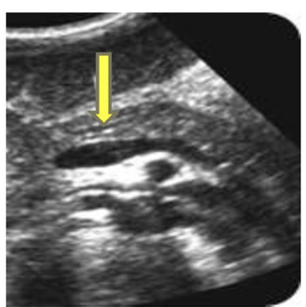 <p>Main pancreatic duct</p>