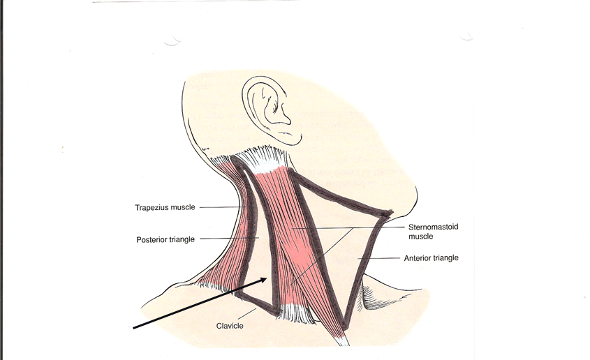 <p>Which triangle of the neck is this?</p>