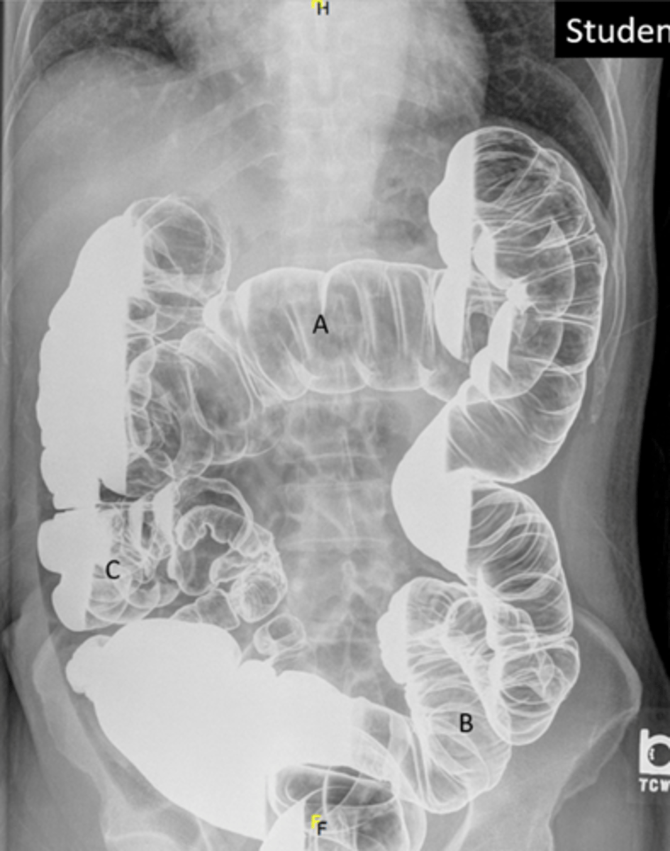 <p>A: transverse colon</p><p>B: Sigmoid Colon</p><p>C: Cecum</p><p>F: Rectum</p>