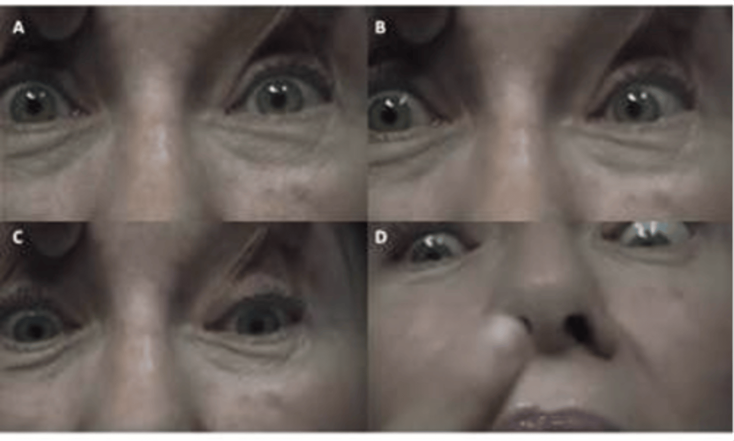<p>Associated with Parkinson's and characterized by supranuclear ophthalmoplegia</p><p>Primarily downward gaze paresis, followed by paresis of other eye muscles</p>