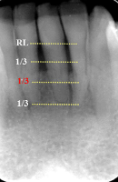 <p>loss of height around multiple teeth may involve furcation</p>
