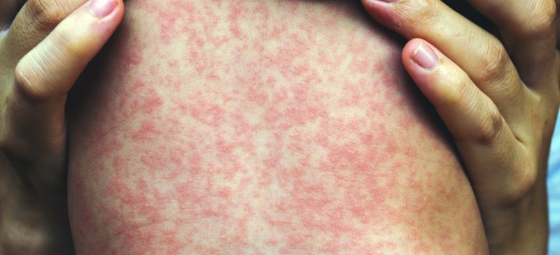 <p>What is the most common vector for <span style="color: #ff00e2"><strong>Rickettsia rickettsii</strong></span>, the causative agent of Rocky Mountain spotted fever?</p><p>A. Flea<br>B. Louse<br>C. Mosquito<br>D. Tick</p><p><br></p>