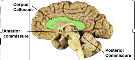 <ul><li><p><span>Corpus Callosum</span></p><ul><li><p><span>Large bundle of axons that connect the two hemispheres, except the Temporal lobe which are connected by the anterior commissure</span></p></li></ul></li></ul><p></p>