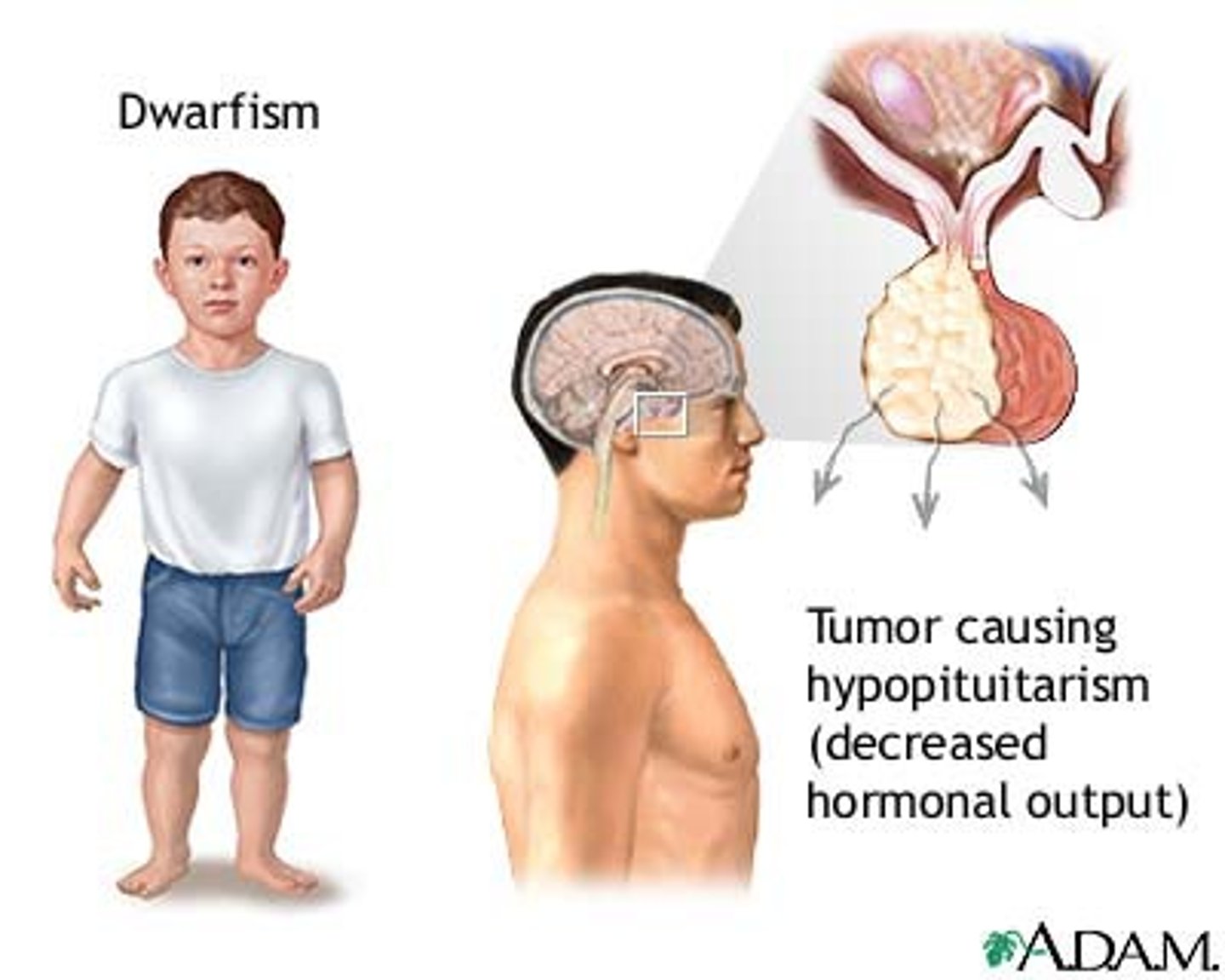 <p>- hyposecretion or hypersecretion (primarily use BW to measure)</p><p>- s&s will be directly related to excess or deficit of the expected hormone level</p>