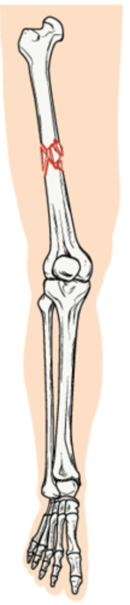 <p>Fracture in which the bone is splintered or crushed</p>