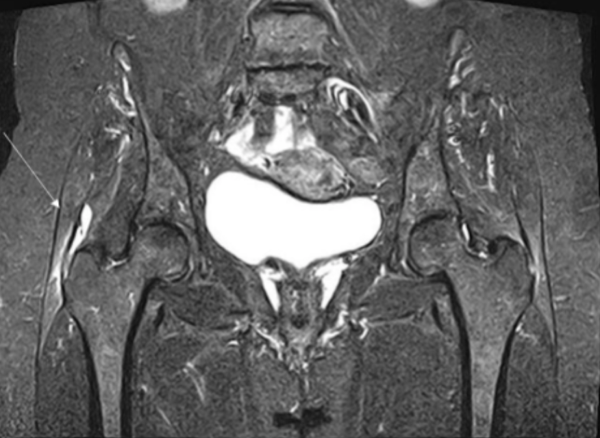 <p>Describe the pathology indicated by the arrow (Cor T2 STIR pelvis). </p>