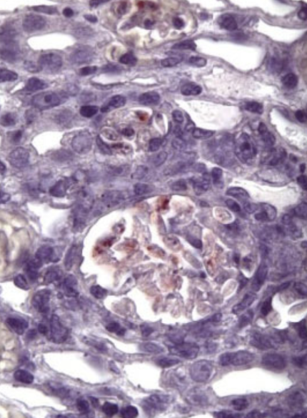 <ul><li><p>Glomeruli obstruction with Ab-Ag or microfilaria</p></li><li><p>Endosymbiotic gram-negative bacteria (Wolbachia pipientis) that have been given via arthropod vectors → trasmitted to microfilariae by adult worms</p></li></ul><p></p>