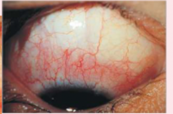 <p>inflammation of the sclera</p>