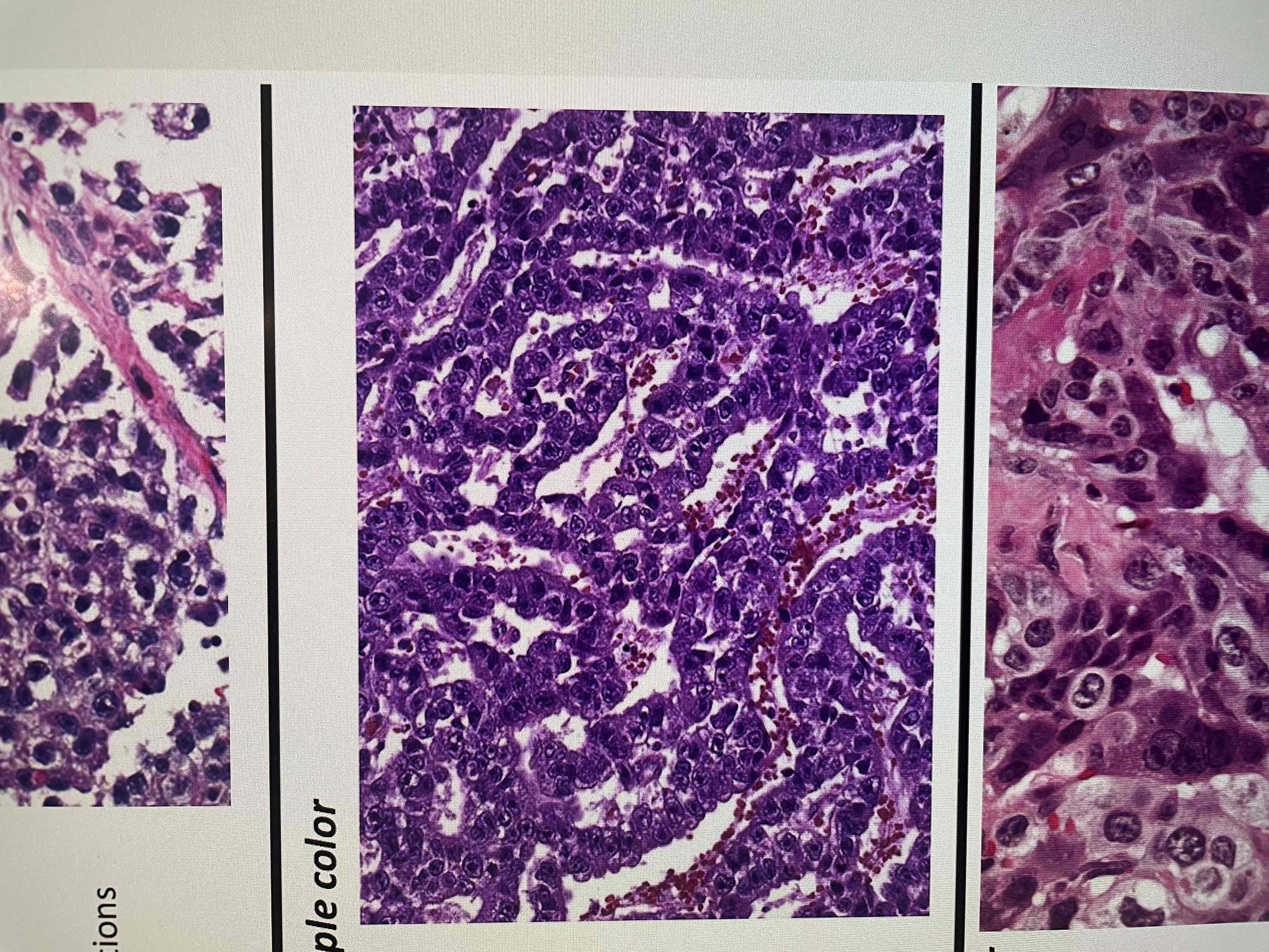 <p>High grade, large cells with vesicular nuclei and  prominent nucleoli forming sheets/ glands, nests (and others - many architecture type) </p><p>Basically Purple high grade looking cell with lots of mitosis </p><p>Aggressive </p>
