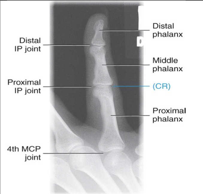 <p><span style="line-height: normal;">• </span>Entire finger and MCP joint demonstrated</p><p class="p1"><span style="line-height: normal;">• </span>Increased concavity of lateral (thumb side) aspect of phalange</p><p class="p1"><span style="line-height: normal;">• </span>Decreased concavity of other aspect</p><ul><li><p class="p1"><span style="line-height: normal;"> </span>Note: opposite will be true for the 2<span style="line-height: normal;">nd</span> digit if it was rotated internally rather than externally</p></li></ul><p class="p1"><span style="line-height: normal;">• </span>Center field at PIP</p><p class="p1"><span style="line-height: normal;">• </span>IP and MP joints are open spaces</p><p class="p1"><span style="line-height: normal;">• </span>Soft tissue demonstrated</p>