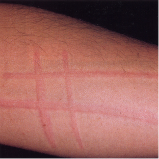 <p>linear urticarial lesions after stroking/scratching skin; &lt; 30 min</p>