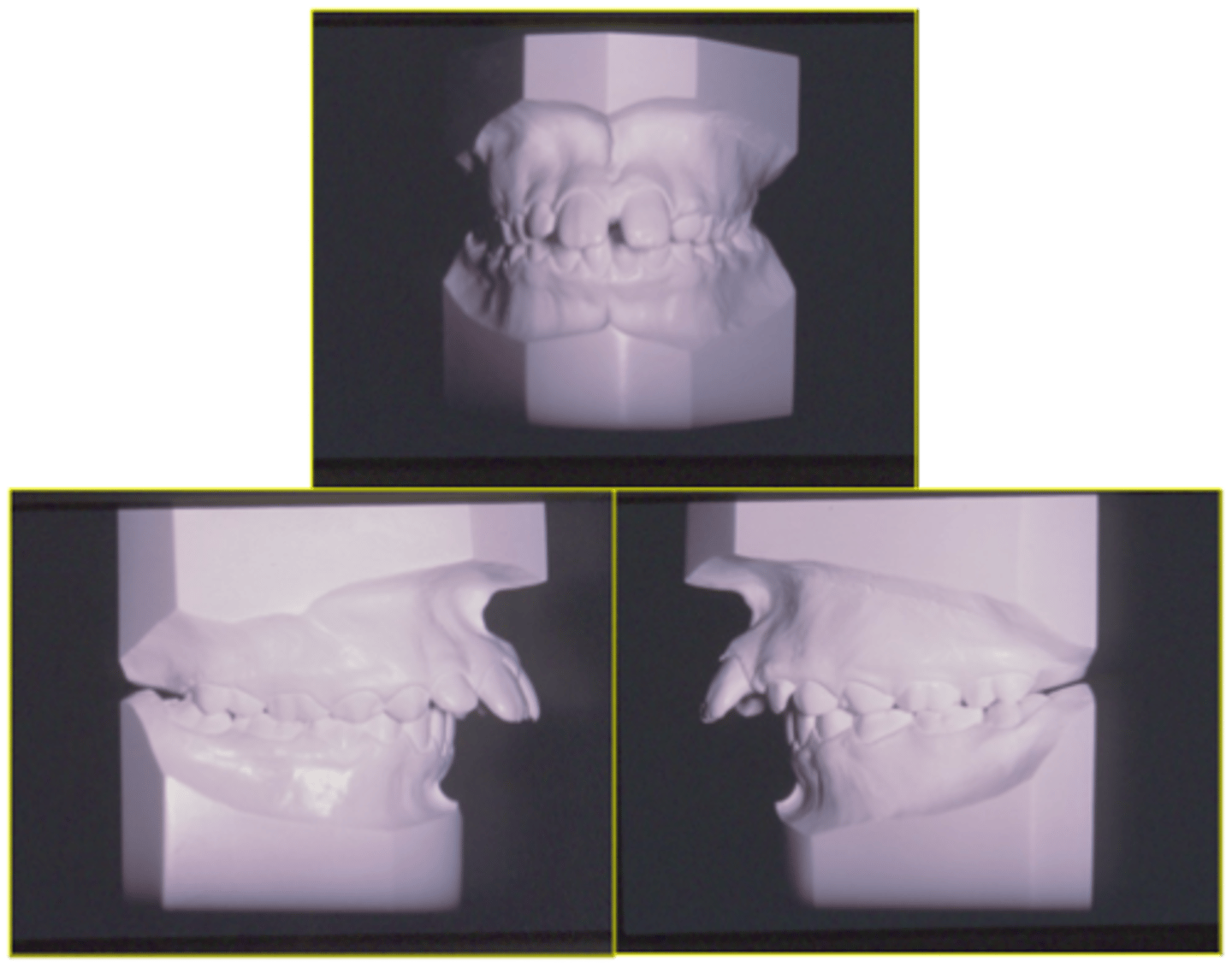 <p>ID the class of occlusion:</p>
