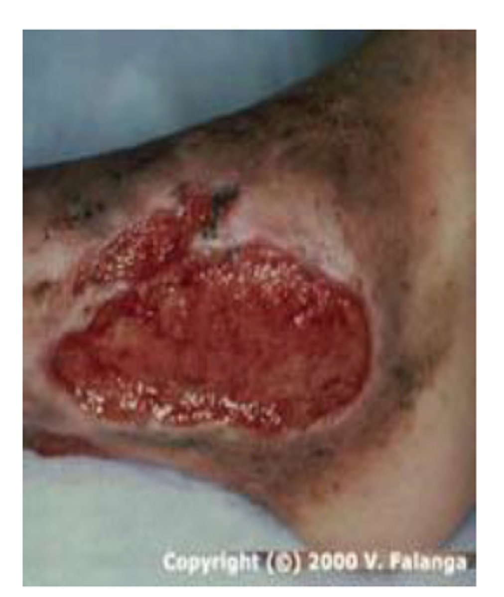 <p>New tissue that is pink/red in color and composed of fibroblasts and small blood vessels that fill an open wound when it starts to heal</p>