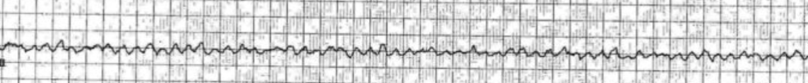 <p>quivering ventricle,no effective contraction, life-threatening without immediate CPR and defibrillation</p>