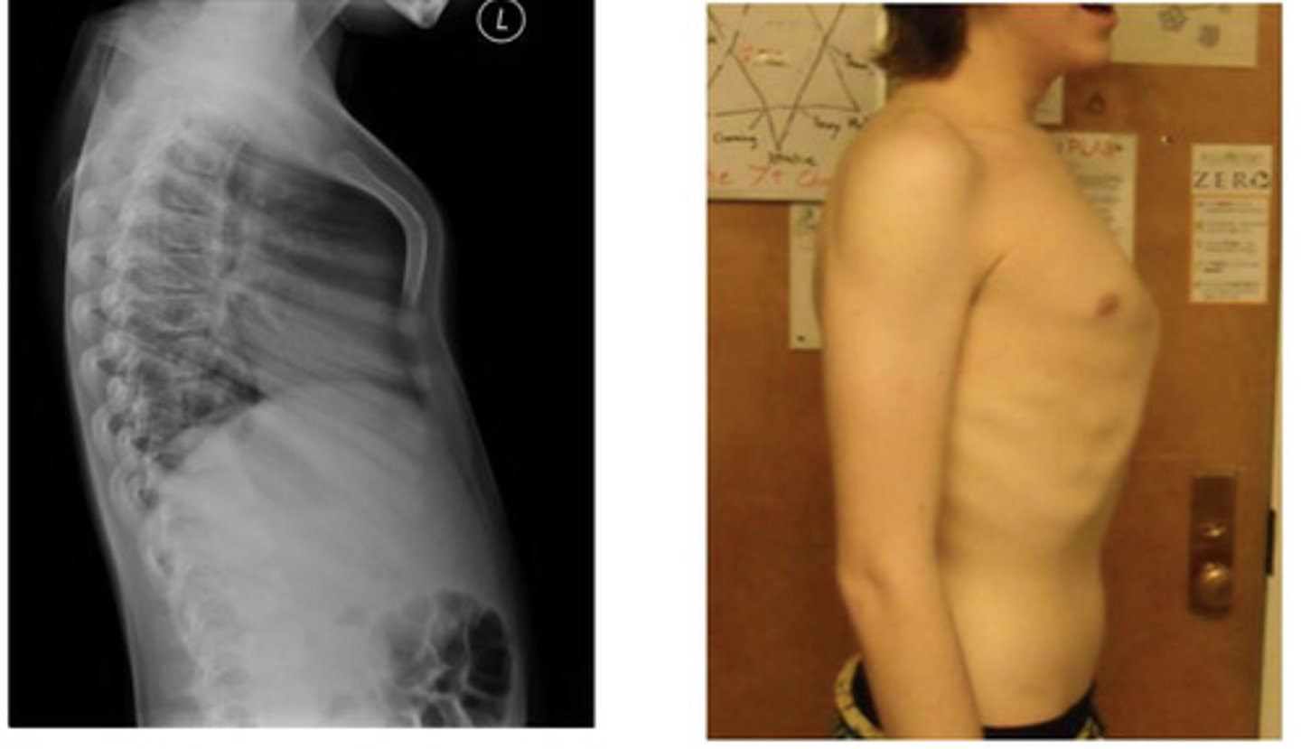 <p>this is the condition in which the sternum (chest wall) protrudes anteriorly</p>