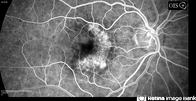 <p>Fluorescein is used to visualise the choroidal vessels and pinpoint the location of leaks and haemorrhages. </p>