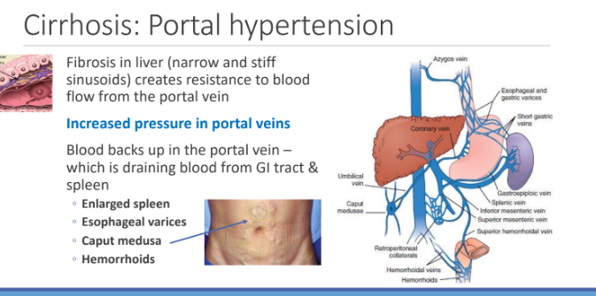 <ol><li><p>Enlarged spleen</p></li><li><p>Esophageal varices</p></li><li><p>Caput medusa</p></li><li><p>Hemorrhoids</p></li></ol><p></p>
