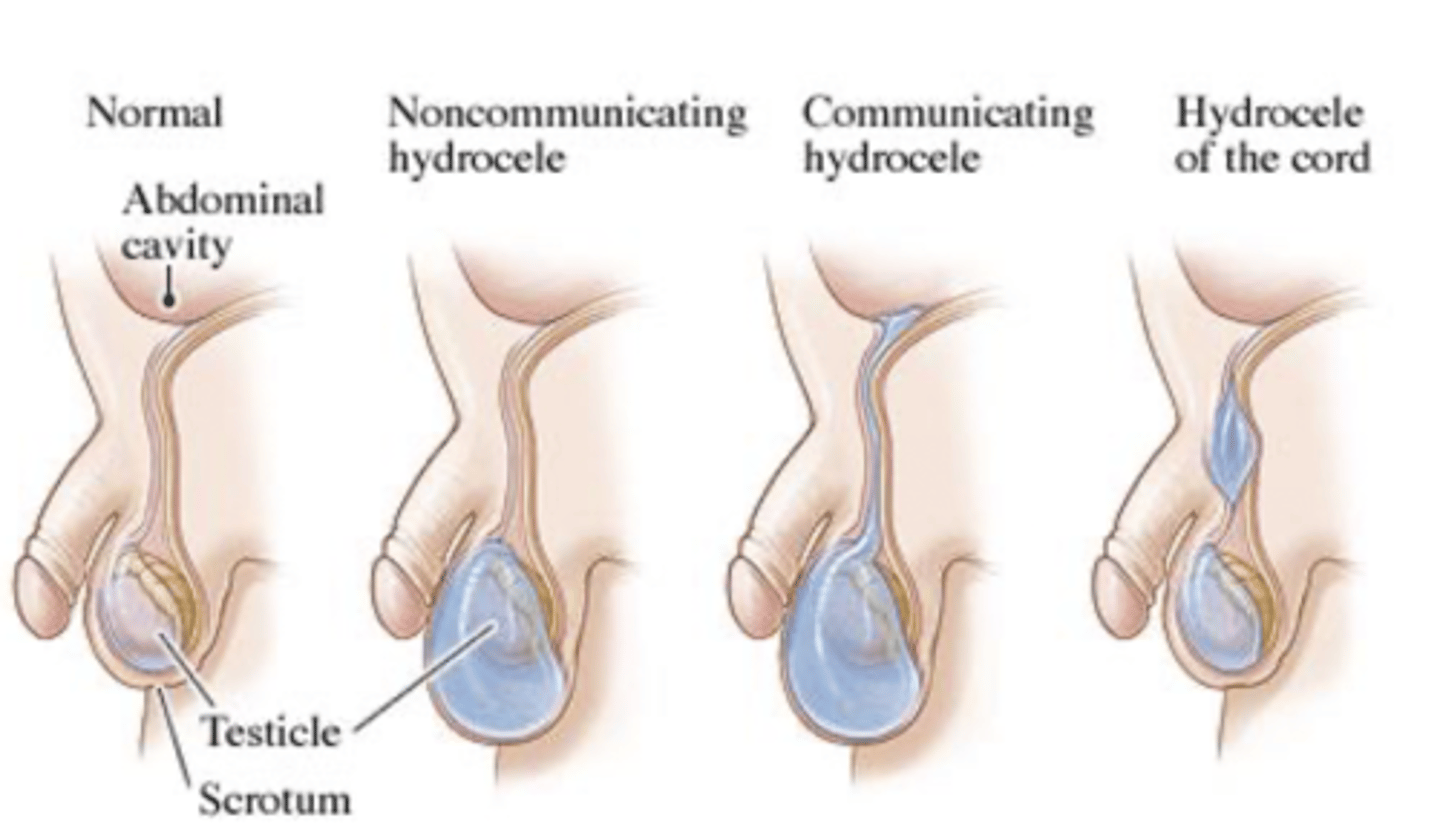 <p>occurs when excessive fluid collects in the space between the layers of the tunica vaginalis of the scrotum</p>