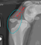 <p><span style="background-color: transparent;"><strong>Tension Band Wiring</strong></span></p>