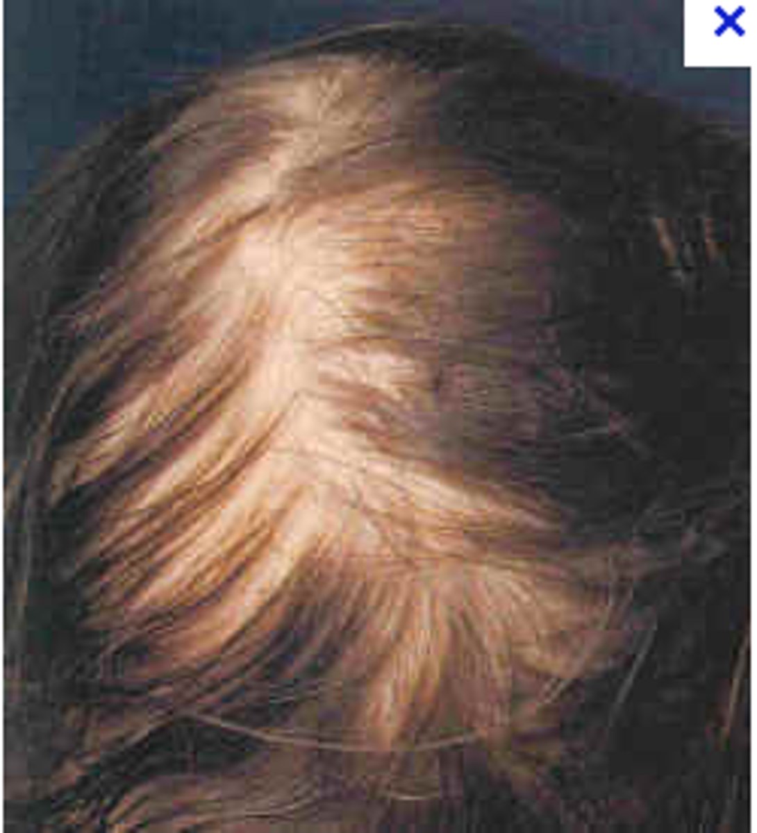 <p>uniform hair thinning, constant shedding of hair</p>