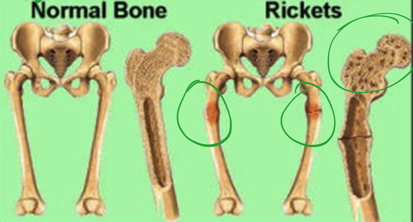 <ul><li><p>disease in children</p></li><li><p>dangerous to children due to their bones growing rapidly </p></li><li><p>epiphyseal plate cannot calcify so long bones become enlarged</p></li><li><p>cannot support weight </p></li><li><p>bending under the pressure </p></li></ul>