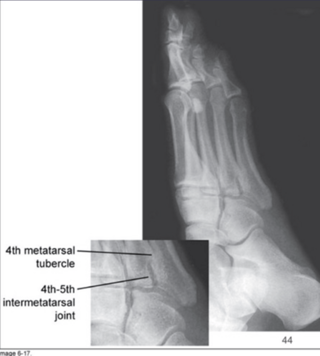 <p>The lateral cuneiform will superimpose the other cuneiforms</p>
