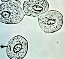 <p>Epithelial cell from renal pelvis, calyces, ureters, bladder, and upper portion of the male urethra</p><ul><li><p>smaller than squamous, similar to RTE but usually with more <u>defined cell edge</u> and <u>central nucleus</u></p></li><li><p>Normal &lt;0-2 /hpf</p></li><li><p>Nonpathological increase: invasive procedures like catheter</p></li><li><p>Pathological: cells w/ abnormal morphology from malignancy or viral infection</p></li></ul><p></p>