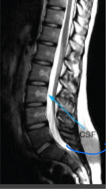 <p>Highlights water as bright</p><p>Fat as slightly less bright</p><p>Muscle as intermediate</p><p>Brain- white matter is darker than gray matter</p>
