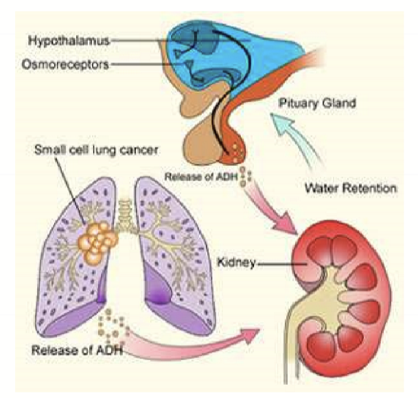 <p>Sydrome of inappropriate ADH/SIADH caused by complications of pituitary tumor or sign of small cell lung cancer.</p>