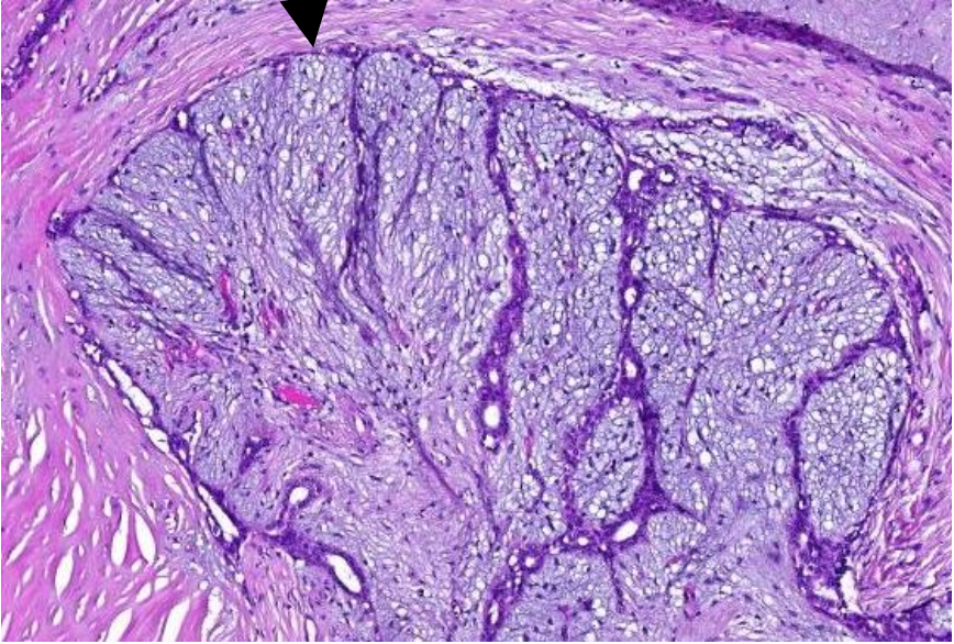 <p>Welke vorm fibroadenoom van de borstklier</p>