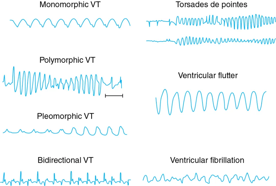 - V tach 
- V fib 
- Torsades de pointes