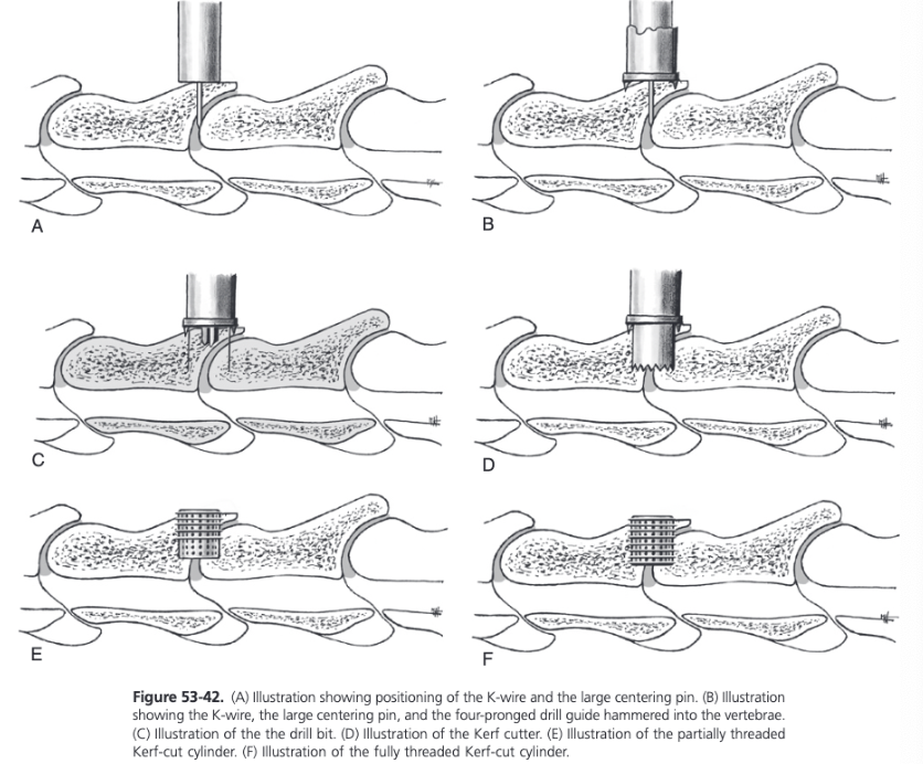 <ul><li><p><span>KCC is a modification of the originally described Bagby Basket</span></p></li><li><p><span>After gaining access to the ventral spine, a curved osteotome is used to remove the ventral spine down to the level of the cervical vertebra creating a triangular platform for placement of the drill guide at the ventral aspect of the vertebral body</span></p></li><li><p><span>The physeal line of the caudal aspect of the vertebra cranial to the articulation can be seen at the caudal edge of the platform in young horses</span></p></li><li><p><span>Since the intervertebral articular surface of the vertebral body is curved cranially, serial drilling will start just cranial to the ventral margin of the articulation ensuring equal engagement of both vertebrae</span></p></li><li><p><span>2-3 K-wires are gently tapped into the cranial and caudal aspects of the disc on the midline, using the spine of the cranial vertebra as a guide</span></p></li><li><p><span>Image is taken to establish which K-wire is correctly placed so the implant will be centered between the two vertebrae and to reconfirm these are the correct vertebrae</span></p></li><li><p><span>Large centering pin is placed over the chosen K-wire, the four-pronged drill guide is placed over the centering pin and hammered securely into the vertebrae as close to perpendicular to the spinal canal as possible</span></p></li><li><p><span>The K-wire and centering pin are removed</span></p></li><li><p><span>Implant site is prepared by drilling with a series of drills starting with a narrow core saw before using the large core saw</span></p></li><li><p><span>16 mm drill bit is used followed by a 25 mm drill bit</span></p></li><li><p><span>Drilling depth should be 25 to 30 mm but must not be less than 10 mm from the spinal canal</span></p></li><li><p><span>The shelf of bone should be left between the bottom of the drill hole and the spinal canal to provide overall strength to the articulation during the recovery process</span></p></li><li><p><span>Once the correct depth has been reached, the implant site is initially widened with a No. 1 Kerf Cutter, the drill guide is removed, and the surgical site is further widened using the slightly larger No. 2 Kerf Cutter</span></p></li><li><p><span>Implant site is tapped with the tap that matches the threads of the KCC implant</span></p></li><li><p><span>Implant is inserted until firm resistance is encountered</span></p></li><li><p><span>A partially threaded implant is preferred since this is less likely to cross-thread and drill a separate channel</span></p></li><li><p><span>Full threaded implant is used in situations where a partially threaded implant fails to tighten</span></p><ul><li><p><span>Self-tapping design of the fully threaded implant can permit the implant to be twisted into the spinal canal</span></p></li></ul></li><li><p><span>A spoon curette or disc rongeurs is used to remove as much intervertebral disc material as possible to provide a bleeding surface of bone and to encourage rapid acceptance of the bone graft</span></p></li><li><p><span>During the drilling, an assistant collects bone from the ventral spine and the drilling fragments to prepare a bone graft by dividing the dark red cancellous bone into small pieces and removing disc material and periosteum</span></p></li><li><p><span>Graft is placed firmly inside the implant before routine closure</span></p></li></ul>