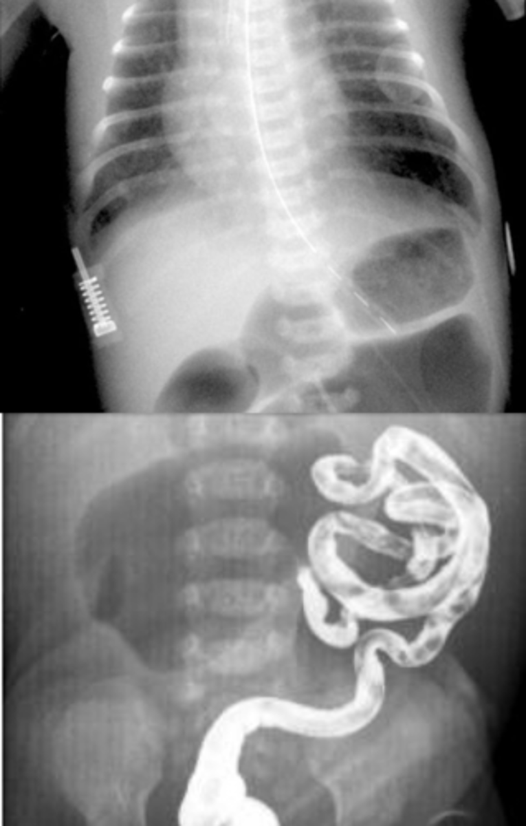 <p>Abdominal x-ray - shows "apple peel" sign or triple bubble sign; contrast enema</p>