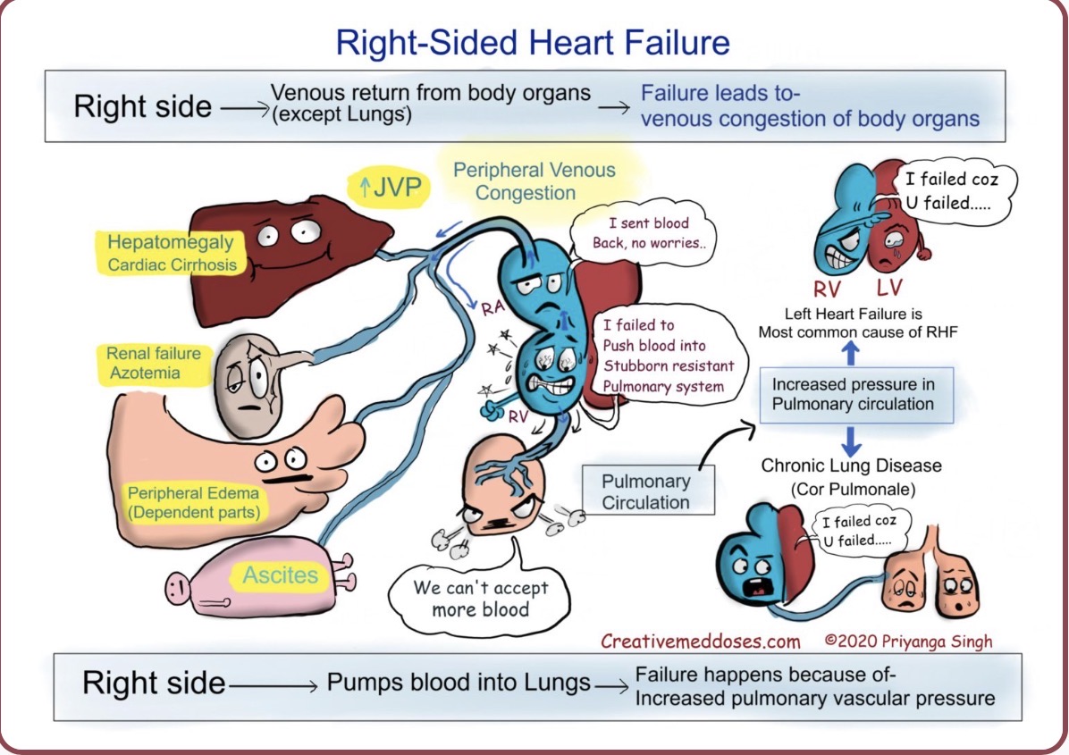 <p>Heart failure type with symptoms including peripheral edema, ascites, and JVD (Jugular Venous Distension).</p>
