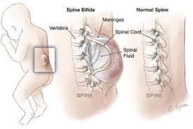 more severe type of spina bifida that involves protrusion of the meninges, spinal cord, or both
