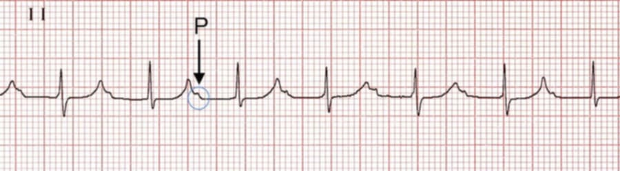 <p>what rhythm is shown in the ECG?</p>