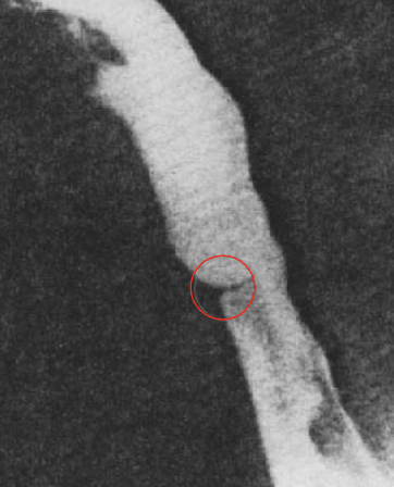 <p>What esophageal disorder is this?</p>