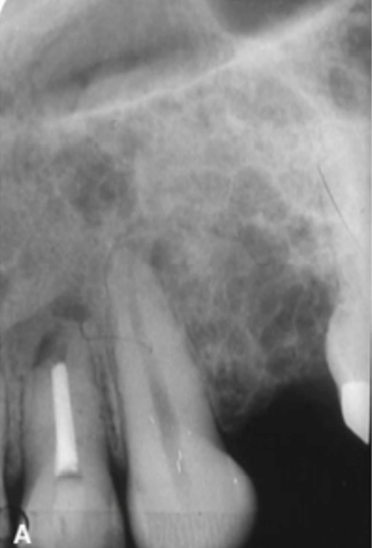<p>less well defined in maxilla with “honeycomb appearance”</p>