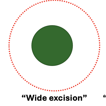 <p>MCT: 2cm lateral</p><p>STS: 3cm lateral</p><p>FISS: 5cm lateral</p>
