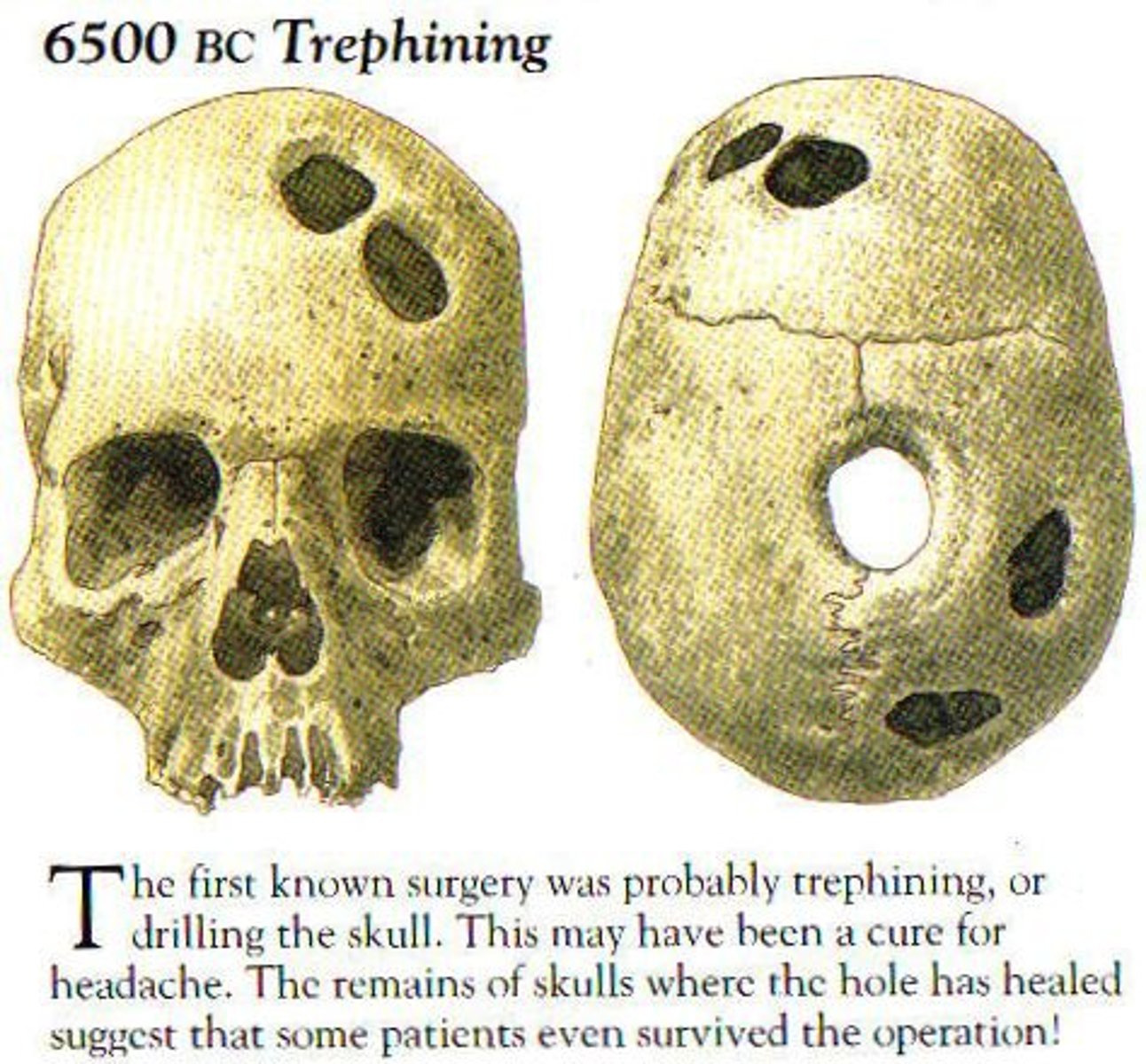<p>An operation to cure a headache which involves creating a hole in the skull. The belief was that it let the bad spirits that caused the headache escape.</p>