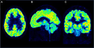 <p>are a neuroimaging technique that uses radioactive tracers to measure brain activity. (injects liquid into brain) <strong>function+Structure</strong></p>