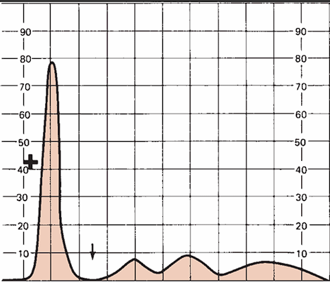 <p>Alpha-1 Antitrypsin (AAT) Deficiency</p>